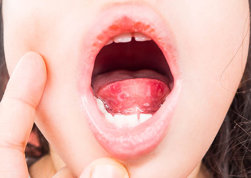 Infezioni della bocca nei bambini: quali sono e come intervenire