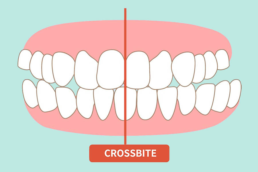 Cosa è il morso crociato: cause e problemi