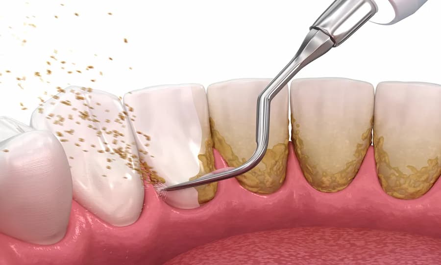 Placca dentale: il vero nemico della salute dentale di tuo figlio